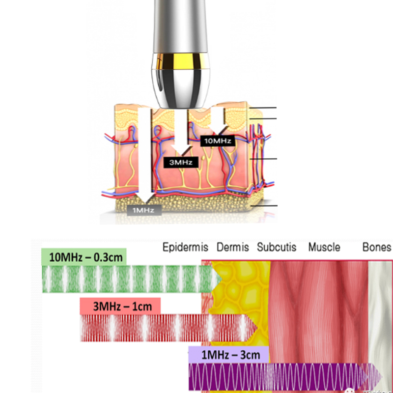 Het door het bedrijf ontwikkelde ultrasone schoonheidsinstrument van 10 MHz